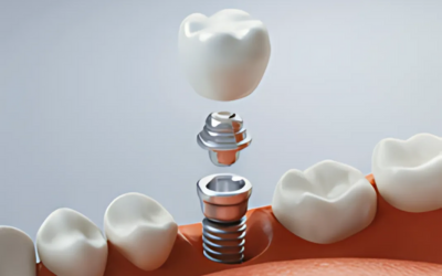 dental implants