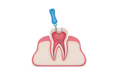 root canal