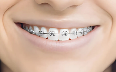 Orthodontic Treatment