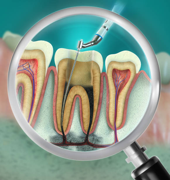 Quick, precise, and virtually painless—Dr. Jindal’s root canal treatments are designed for maximum comfort and long-term relief.