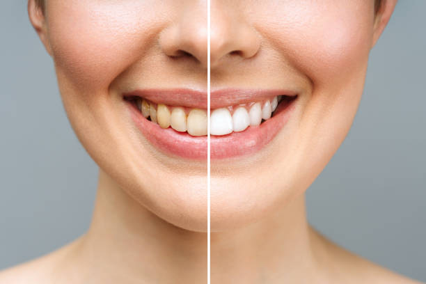 Smile Design with Veneers, Teeth Whitening, and Reshaping