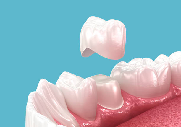 Fixed Teeth Restorations and Crowns