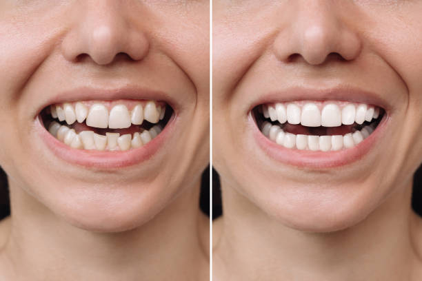 Full-Mouth Rehabilitation