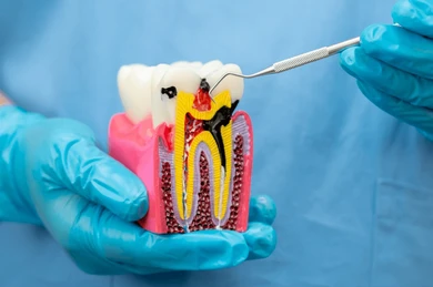 Root-Canal-Treatment