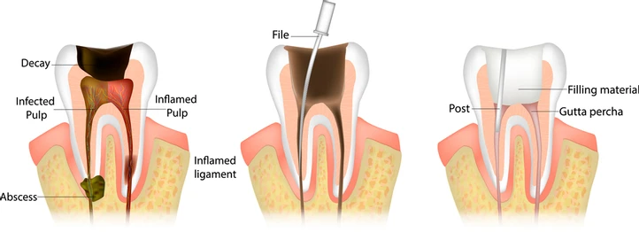 Root-canal-treatment